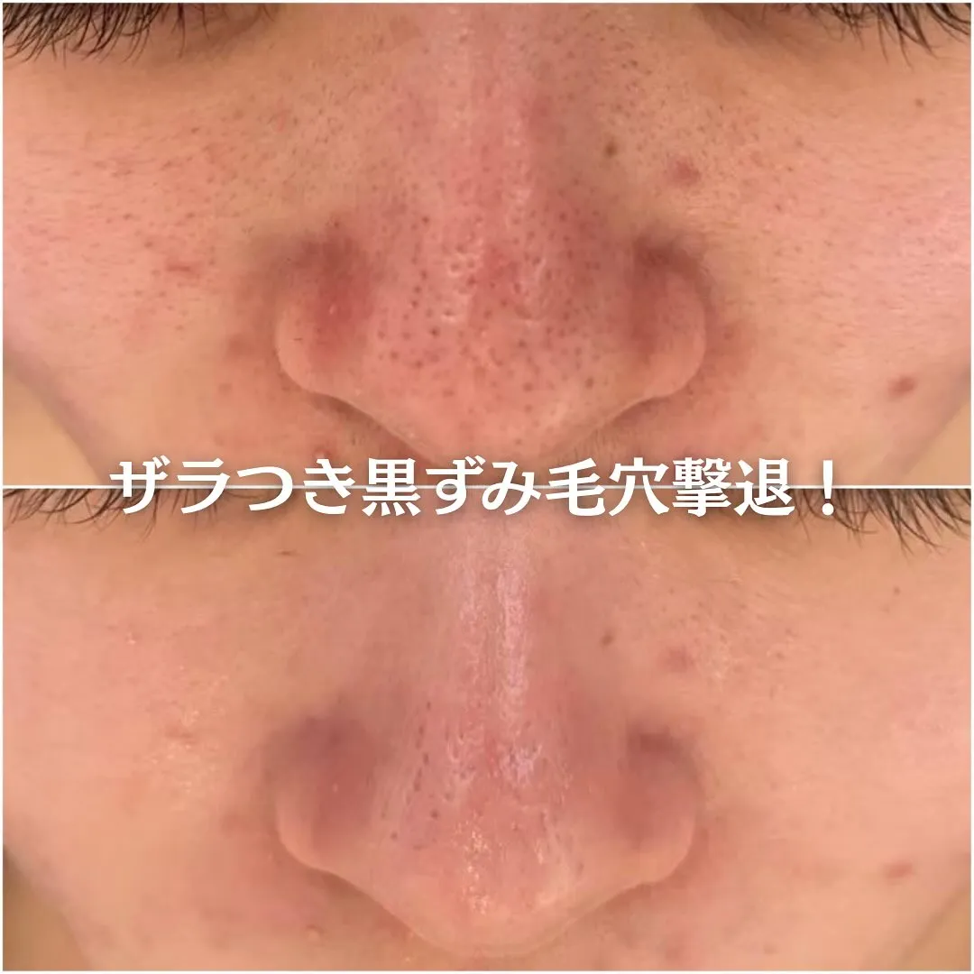 太田市にある頑固なニキビ専門店です✨️