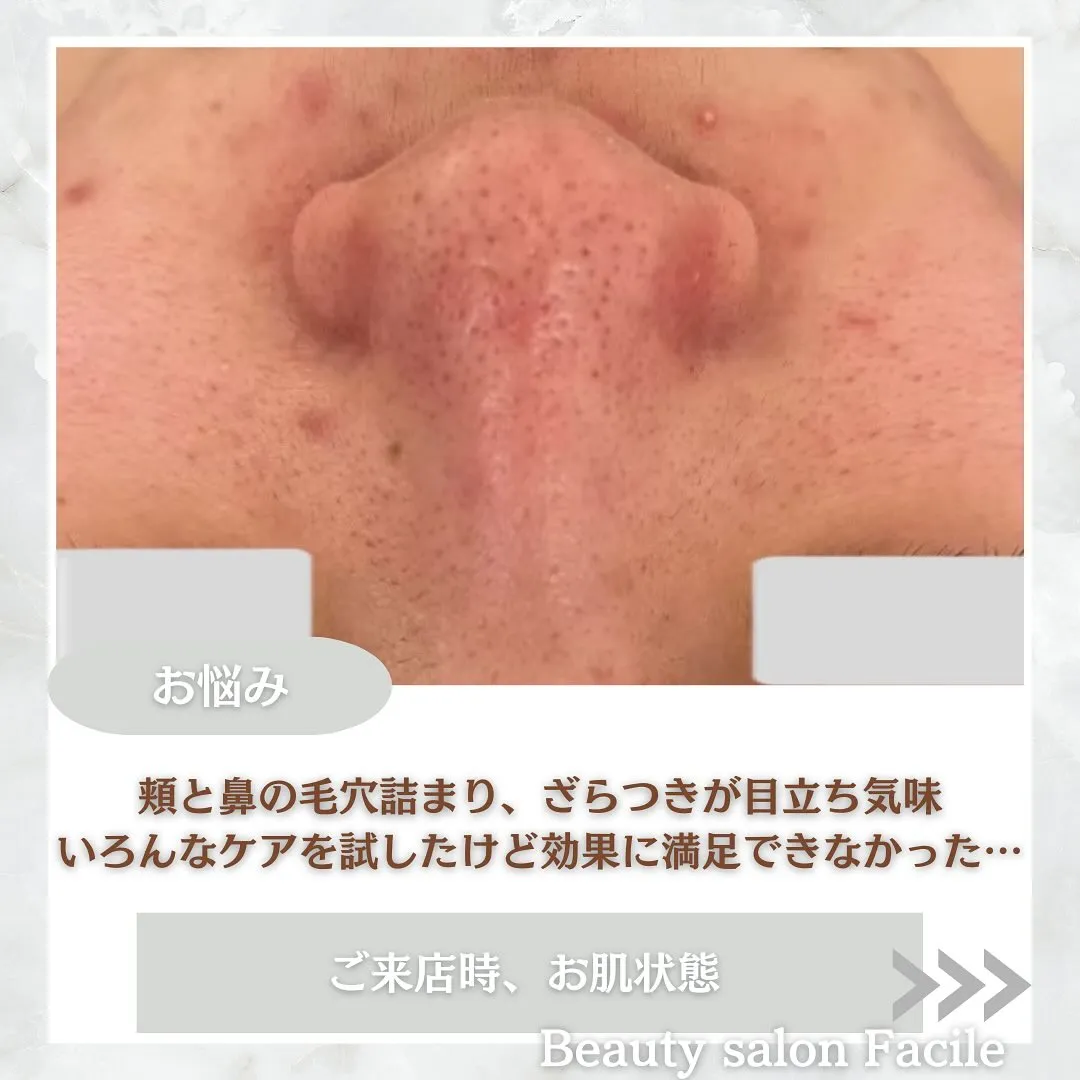 太田市にある頑固なニキビ専門店です✨️