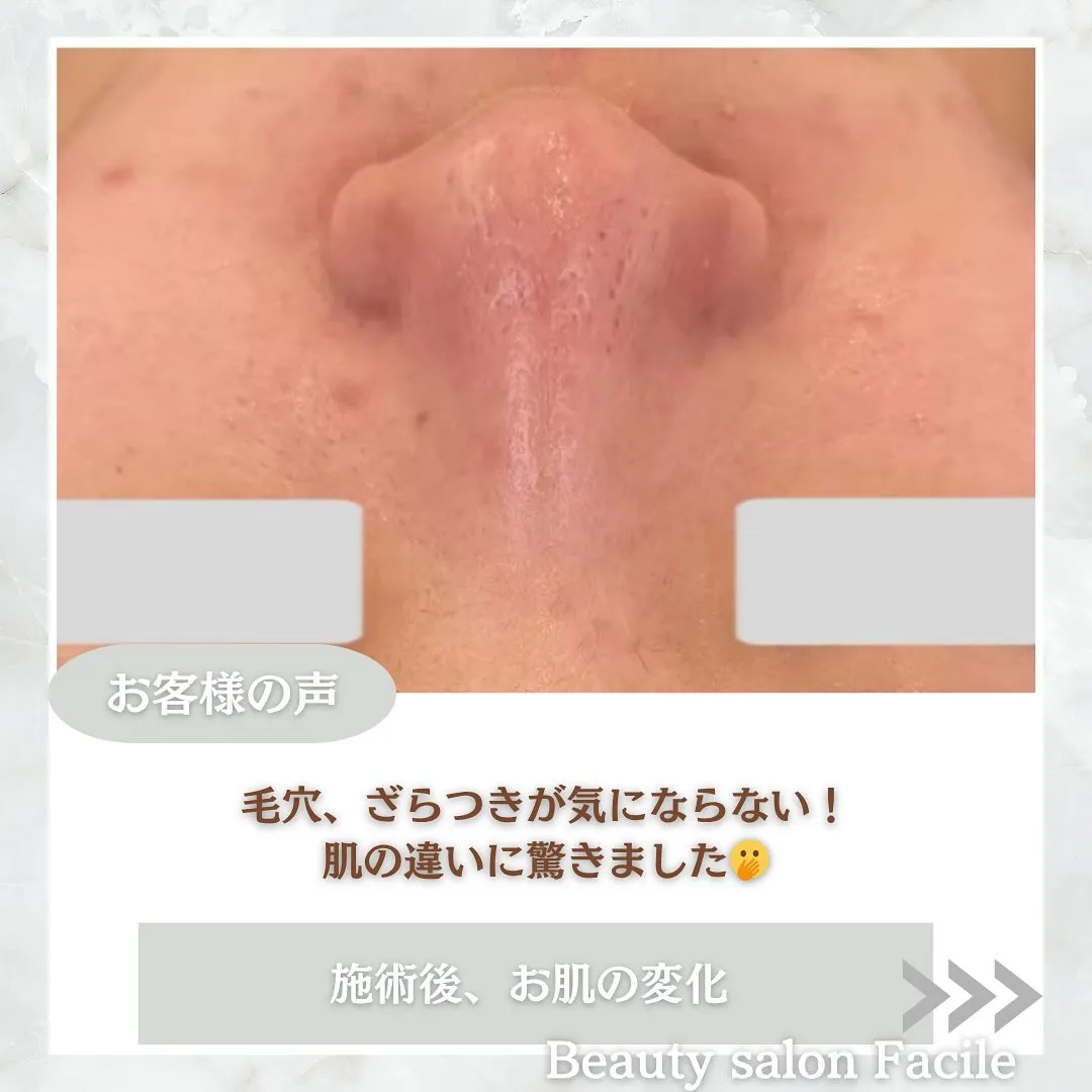 太田市にある頑固なニキビ専門店です✨️