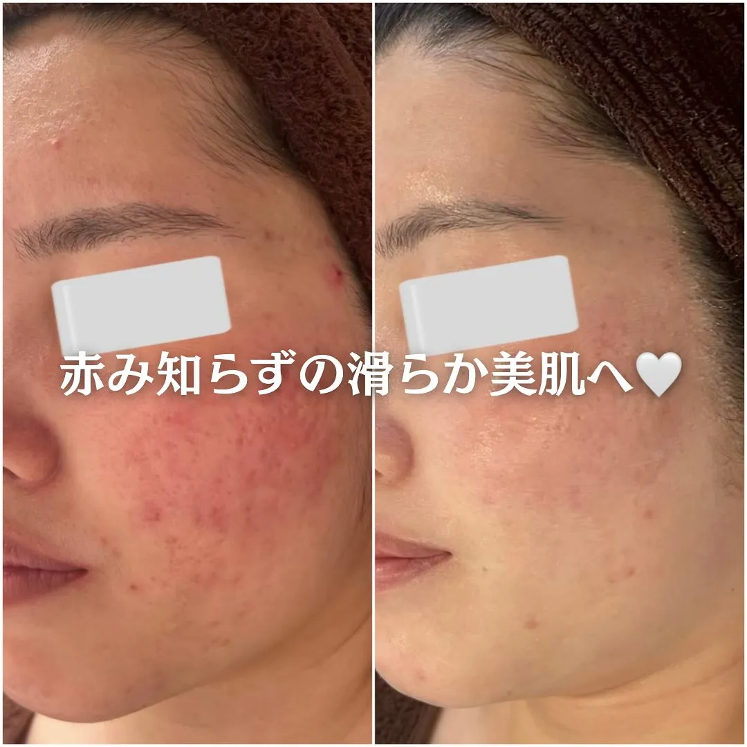 太田市にある頑固なニキビ専門店です✨️