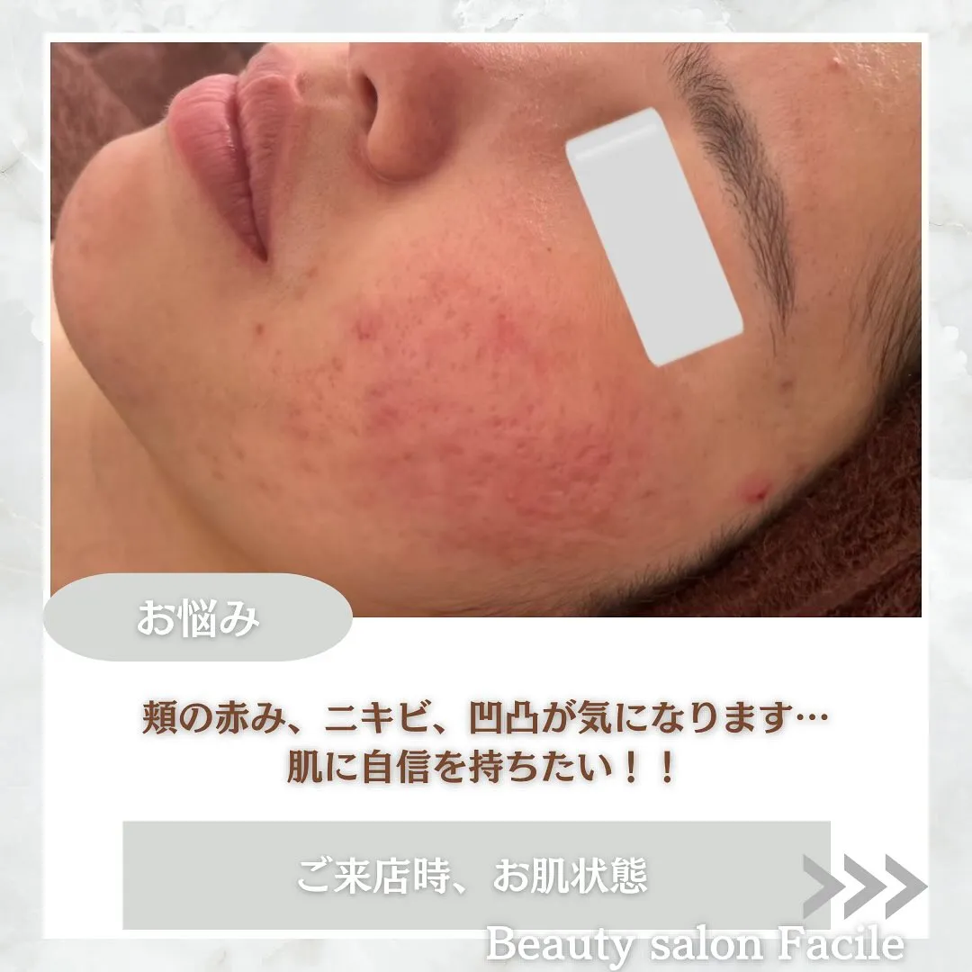 太田市にある頑固なニキビ専門店です✨️