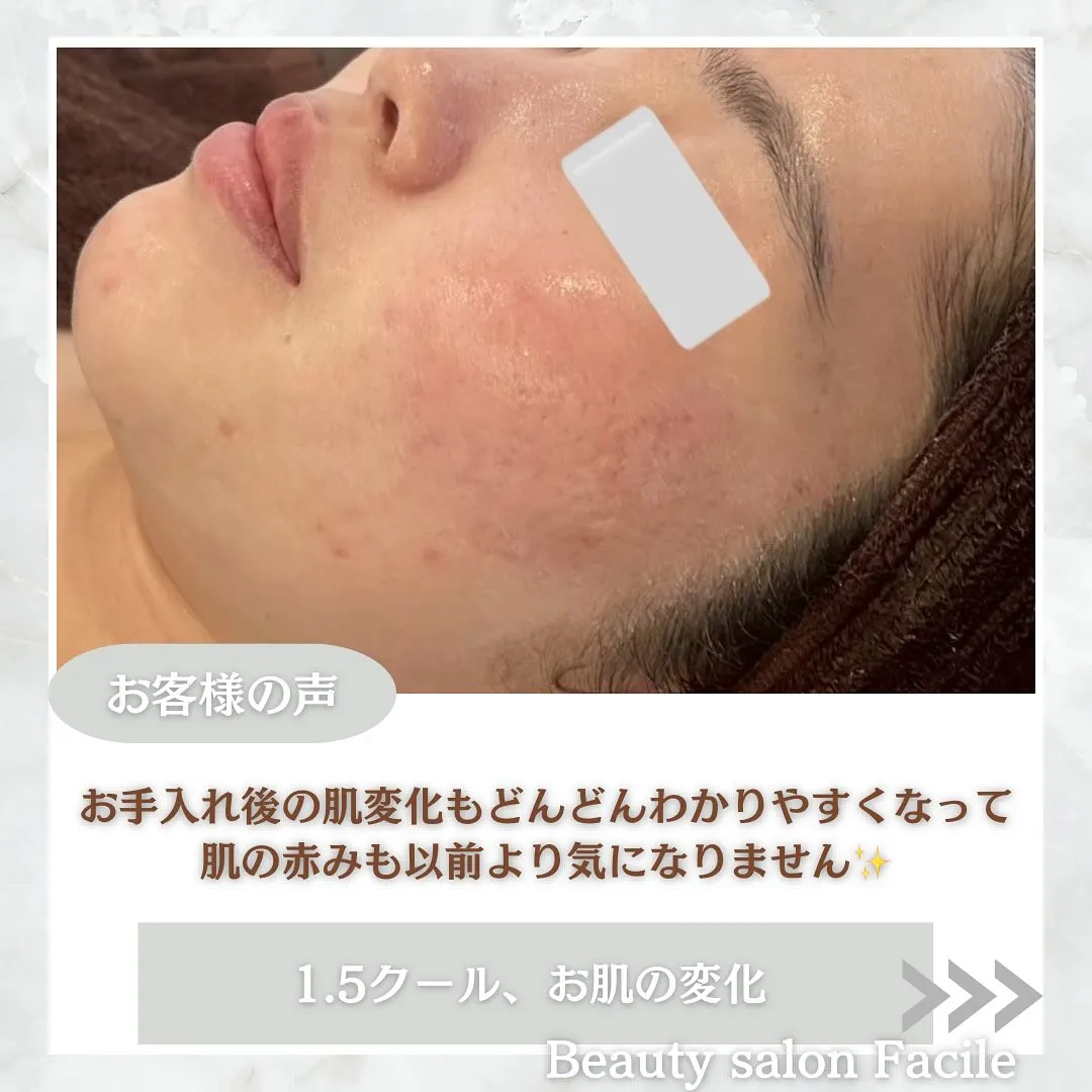 太田市にある頑固なニキビ専門店です✨️