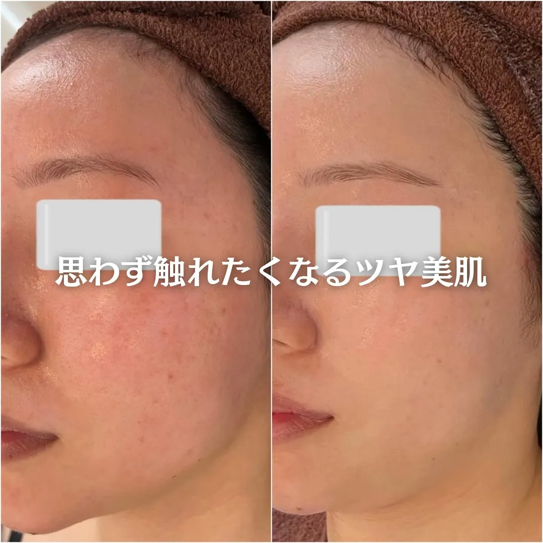 太田市にある頑固なニキビ専門店です✨️