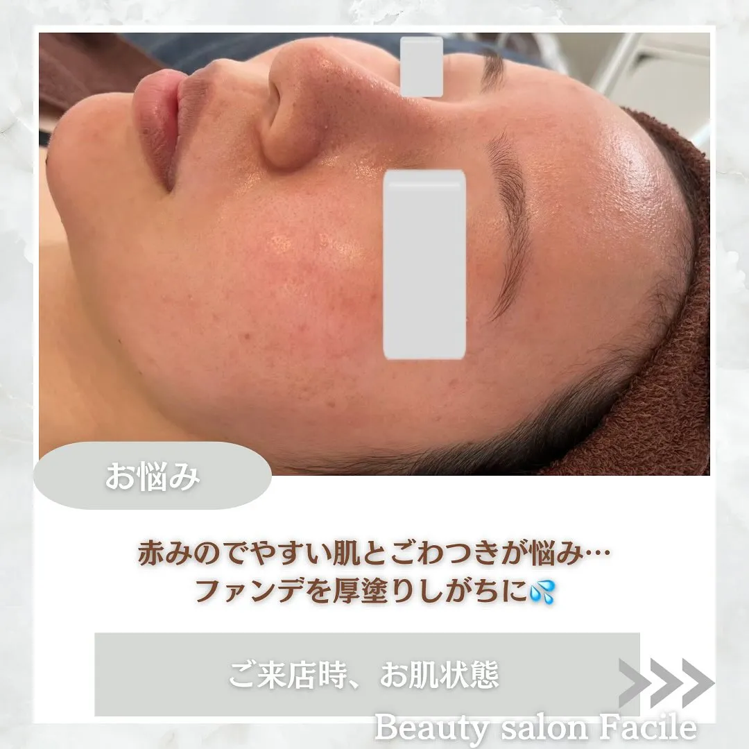 太田市にある頑固なニキビ専門店です✨️