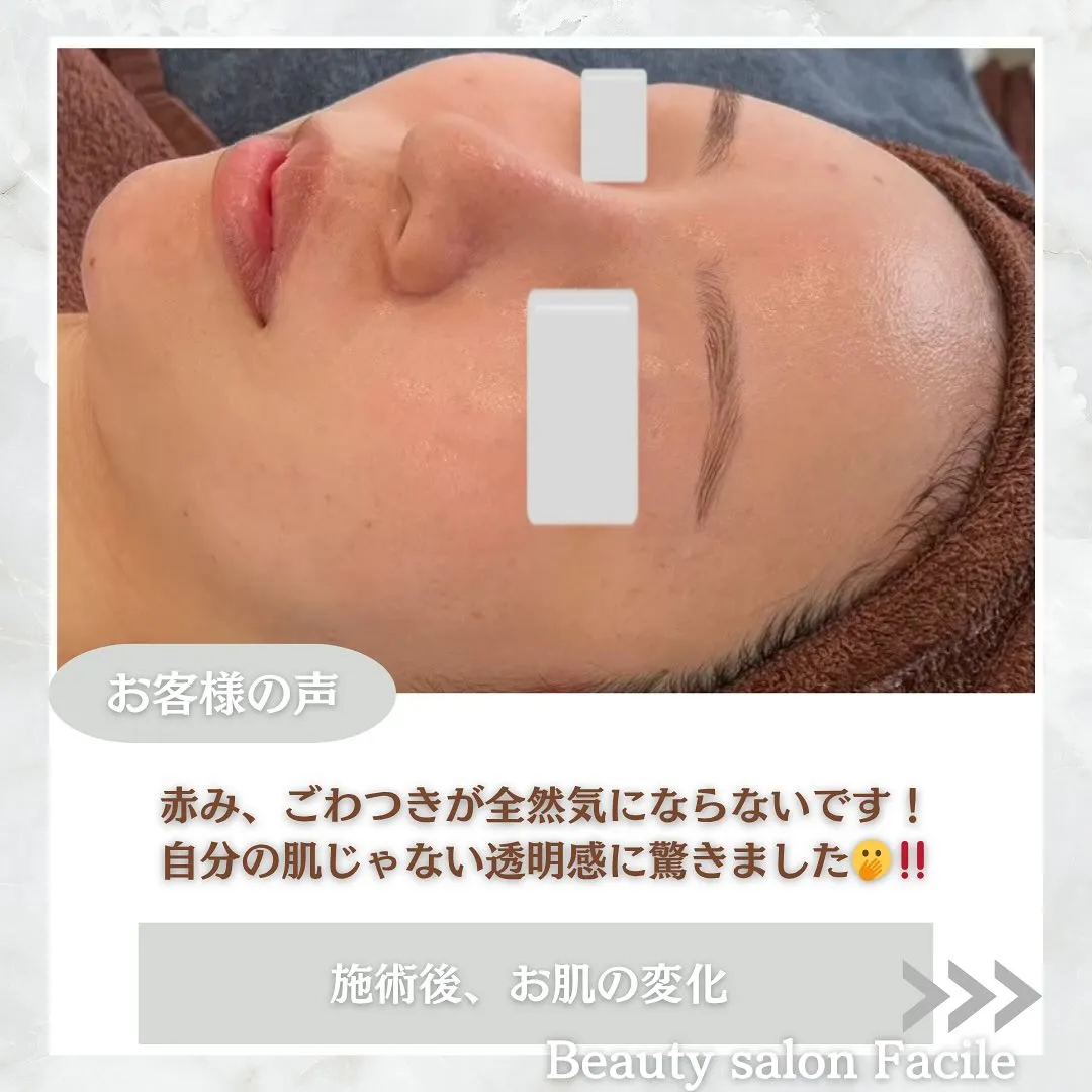 太田市にある頑固なニキビ専門店です✨️