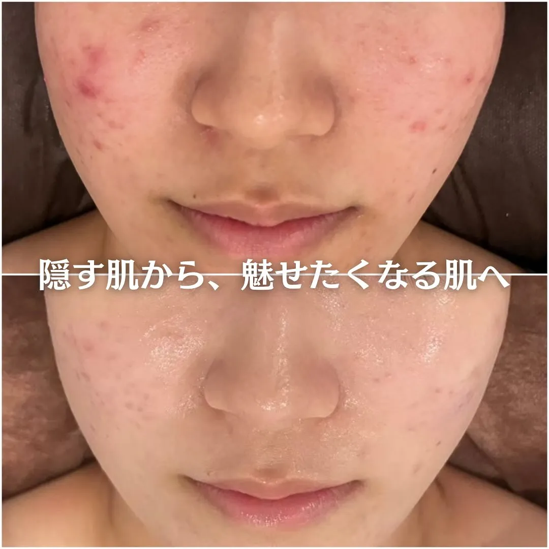 太田市にある頑固なニキビ専門店です✨️