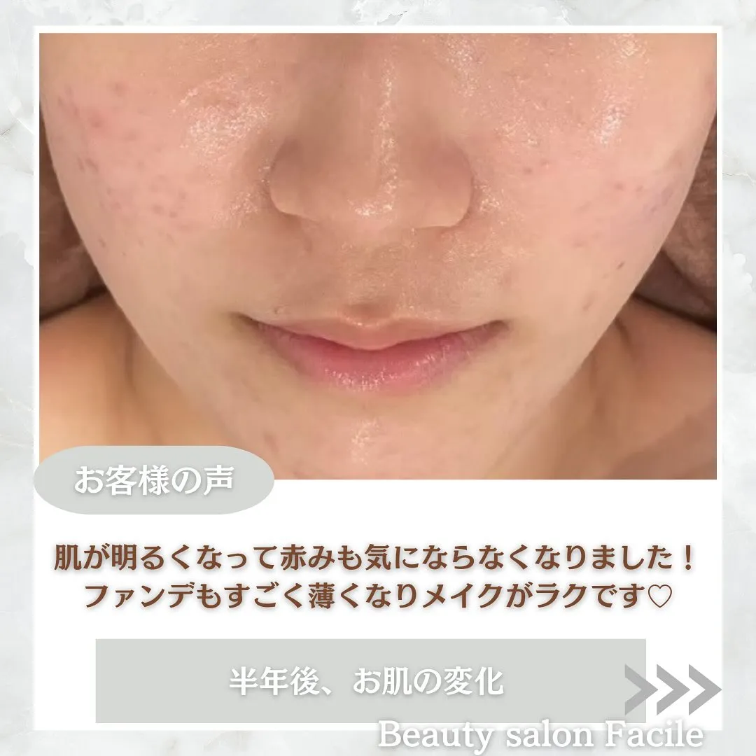 太田市にある頑固なニキビ専門店です✨️