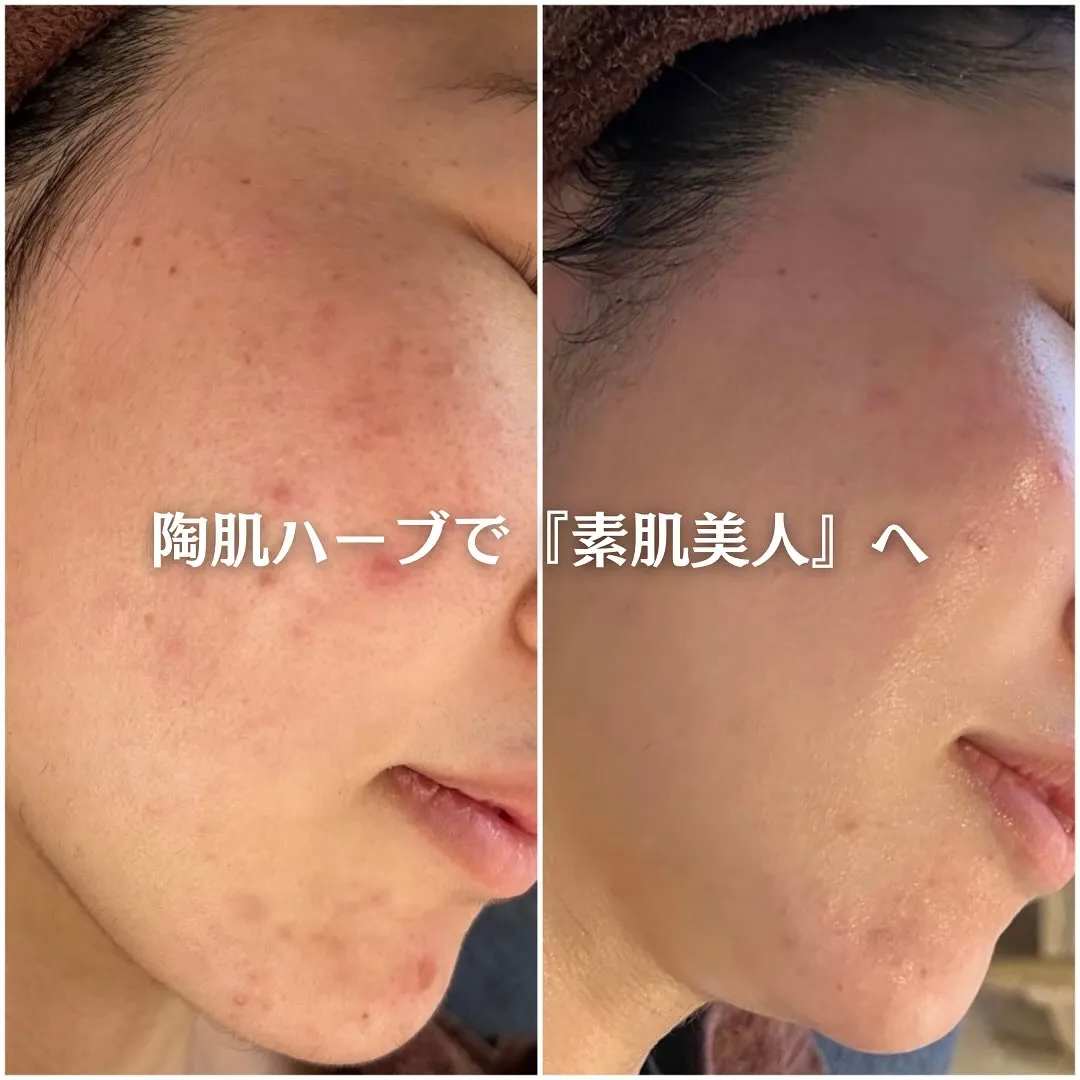 太田市にある頑固なニキビ専門店です✨️