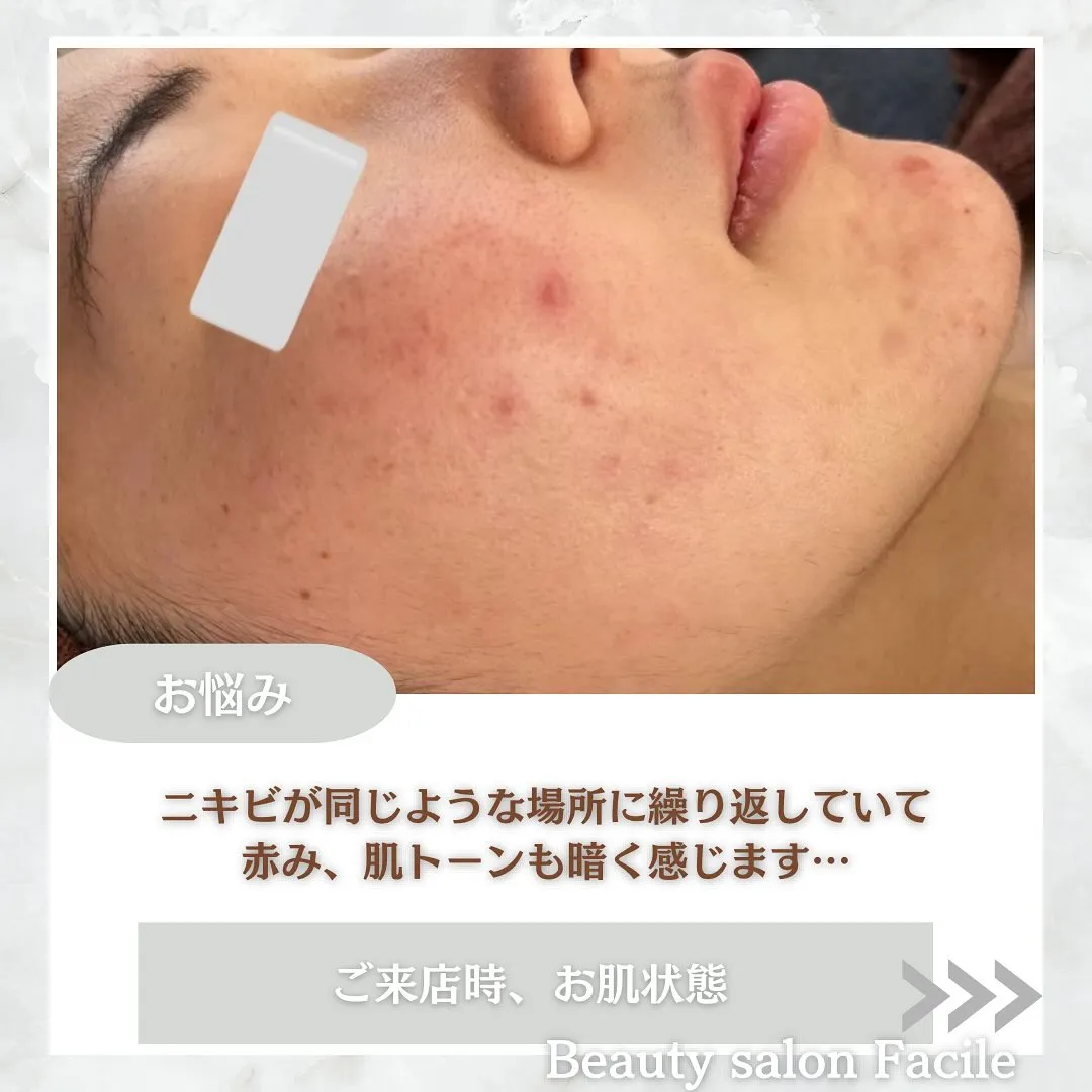 太田市にある頑固なニキビ専門店です✨️