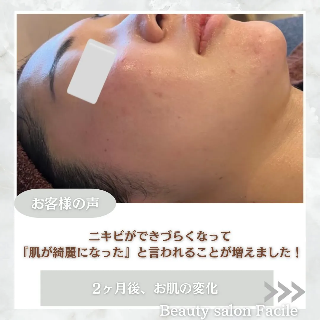 太田市にある頑固なニキビ専門店です✨️