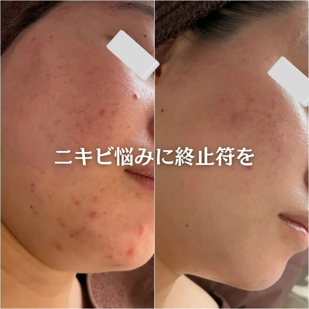 太田市にある頑固なニキビ専門店です✨️