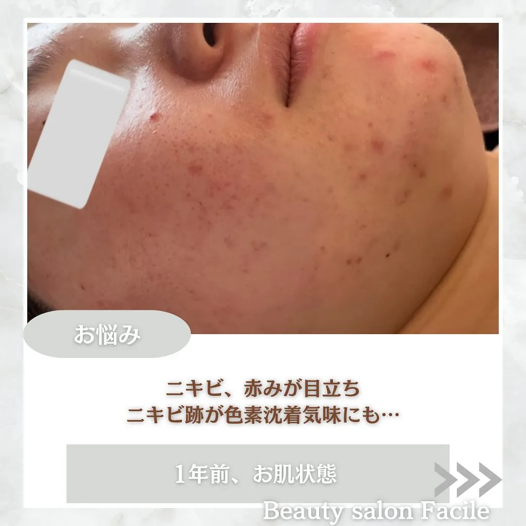 太田市にある頑固なニキビ専門店です✨️