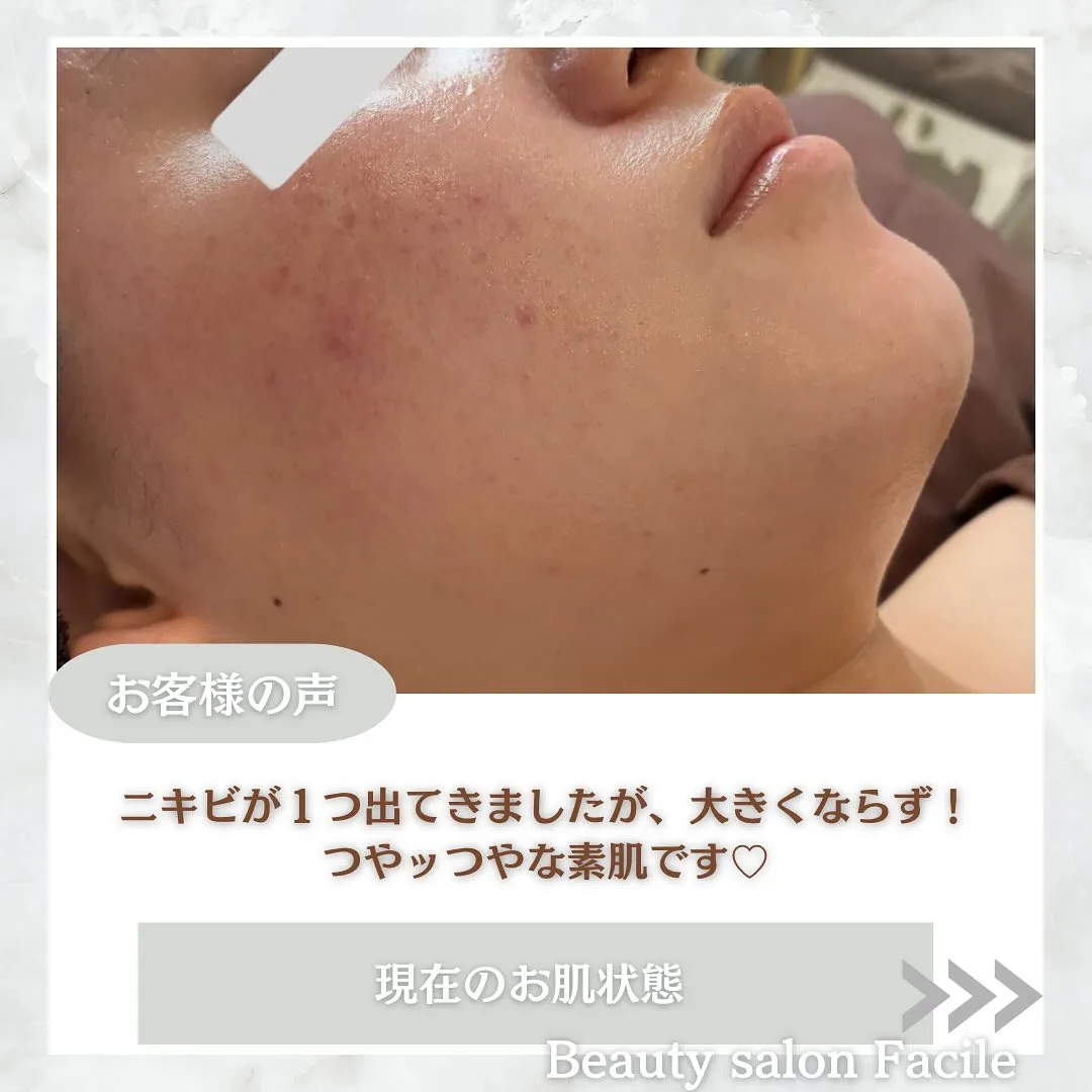 太田市にある頑固なニキビ専門店です✨️