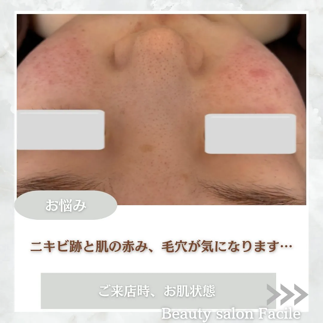 太田市にある頑固なニキビ専門店です✨️