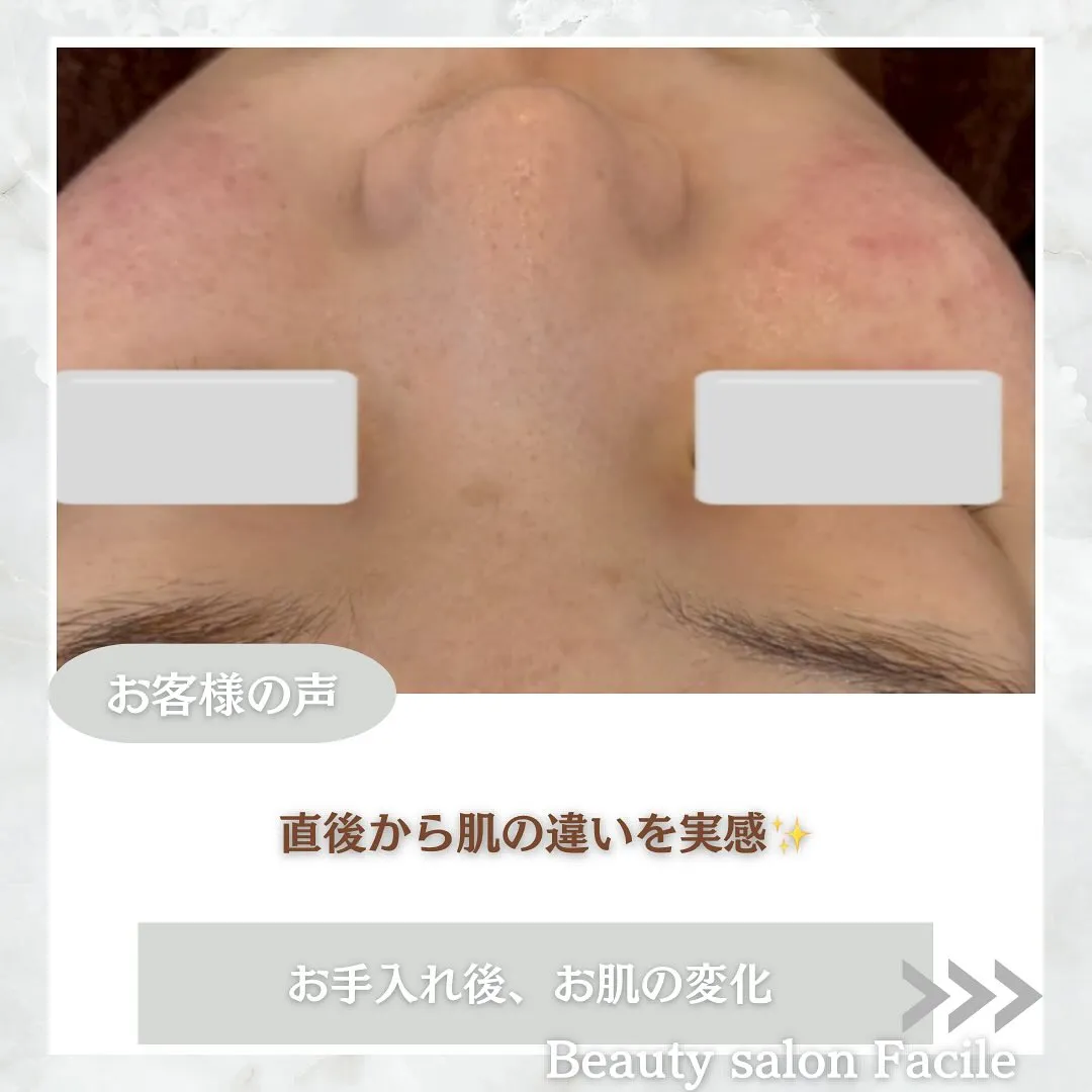 太田市にある頑固なニキビ専門店です✨️