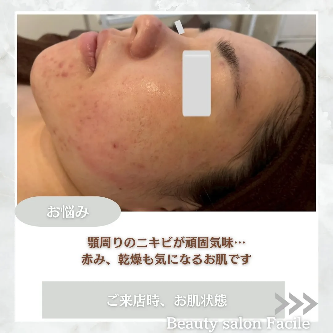 太田市にある頑固なニキビ専門店です✨️
