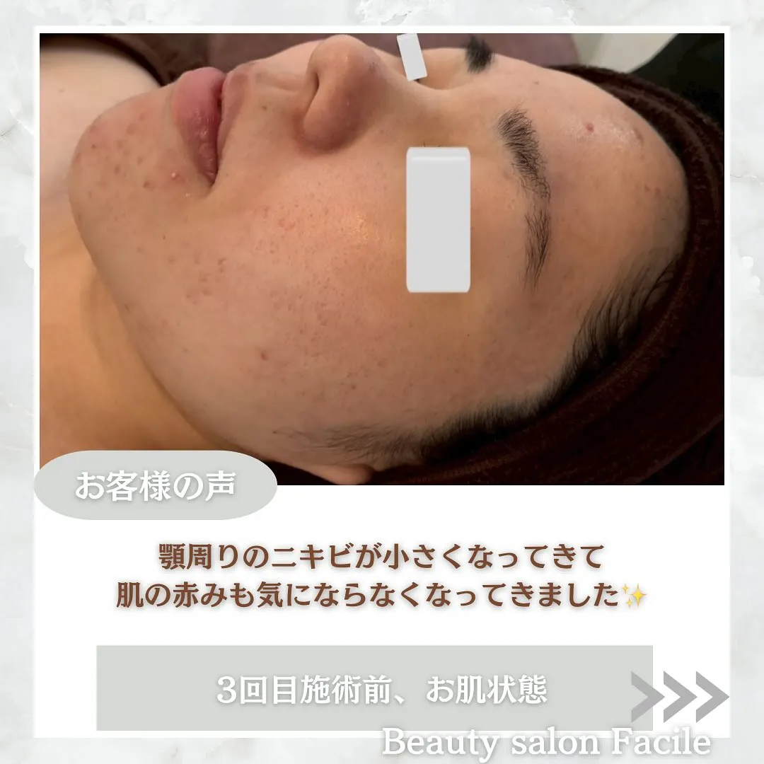 太田市にある頑固なニキビ専門店です✨️