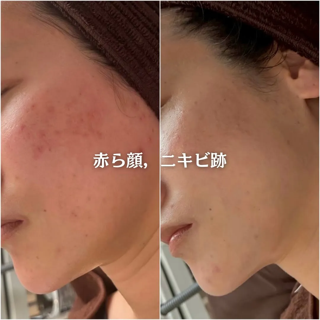 太田市にある頑固なニキビ専門店です✨️