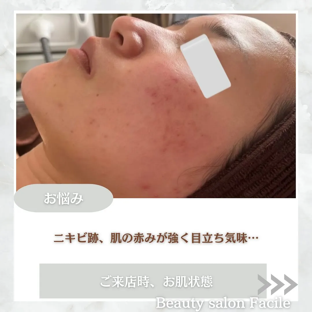 太田市にある頑固なニキビ専門店です✨️