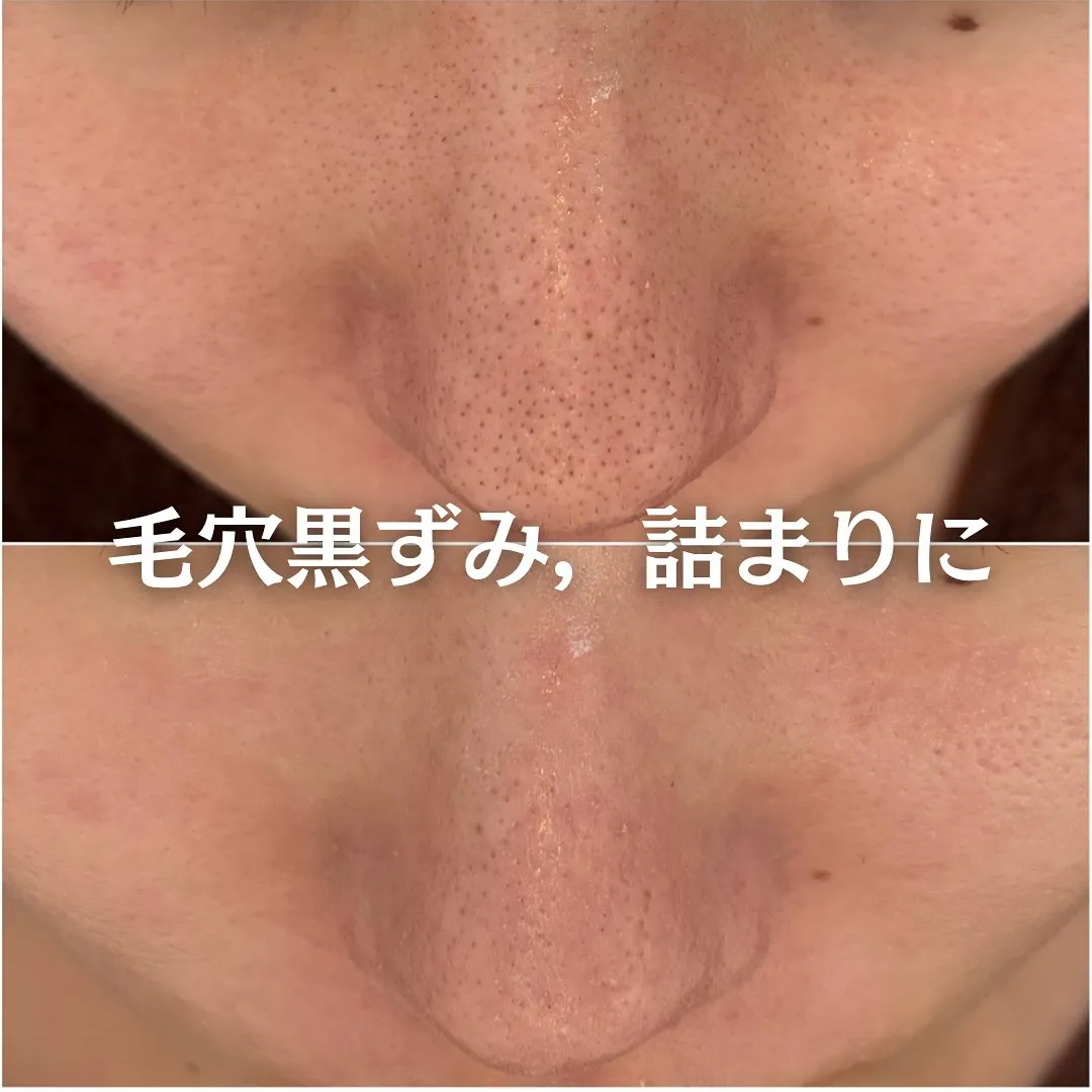 太田市にある頑固なニキビ専門店です✨️