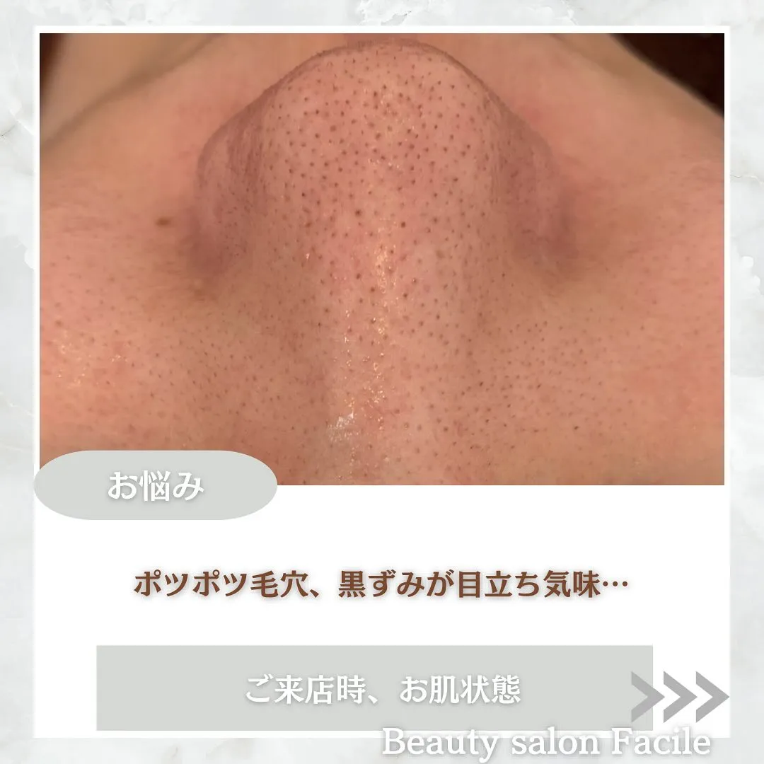 太田市にある頑固なニキビ専門店です✨️