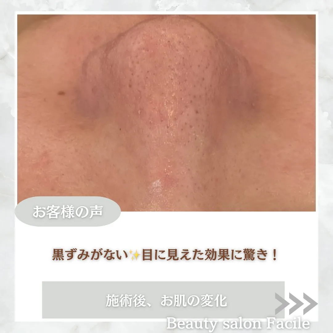 太田市にある頑固なニキビ専門店です✨️