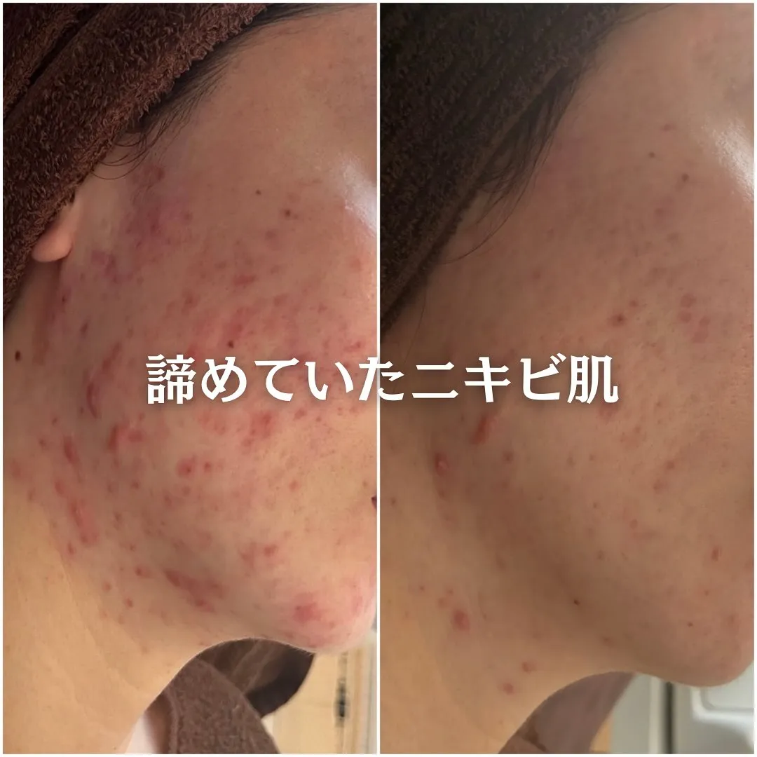 太田市にある頑固なニキビ専門店です✨️