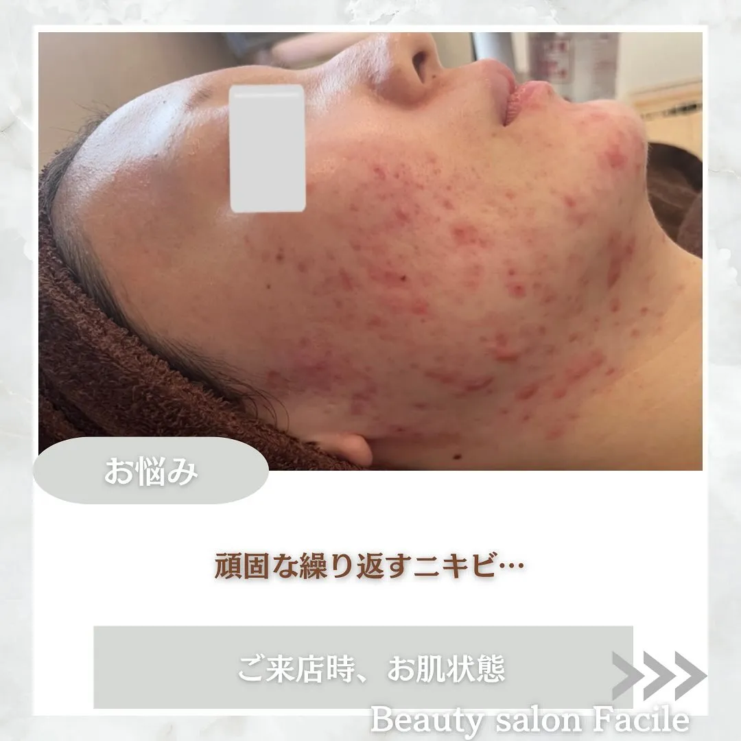 太田市にある頑固なニキビ専門店です✨️