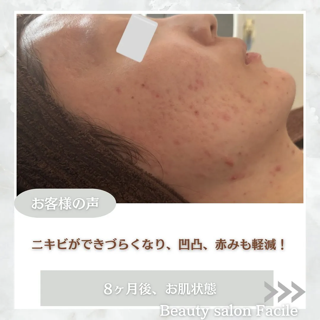 太田市にある頑固なニキビ専門店です✨️