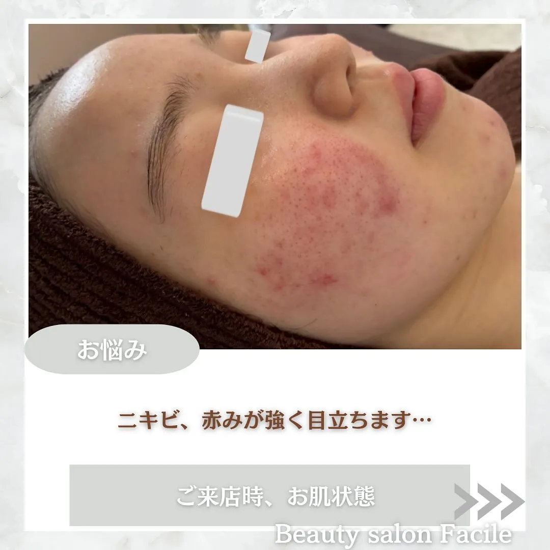 太田市にある頑固なニキビ専門店です✨️