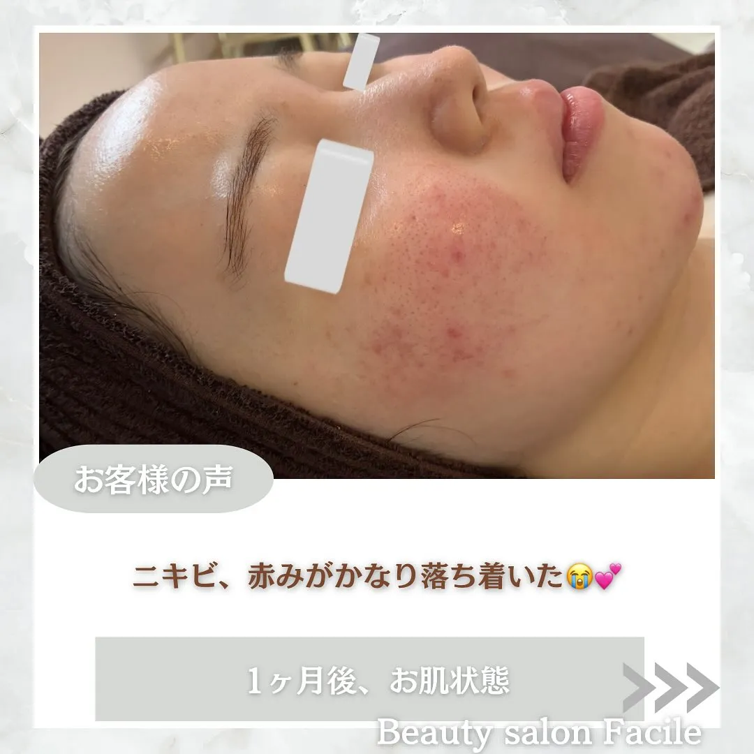 太田市にある頑固なニキビ専門店です✨️