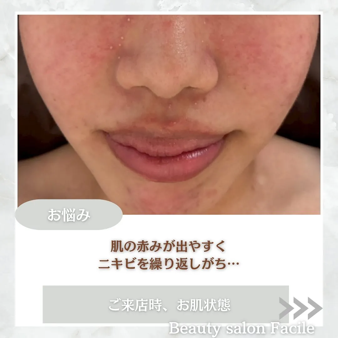 太田市にある頑固なニキビ専門店です✨️