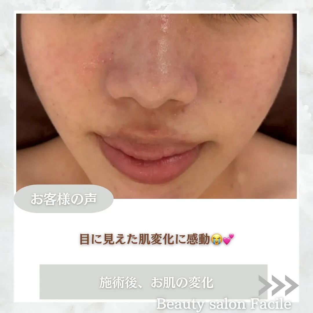 太田市にある頑固なニキビ専門店です✨️