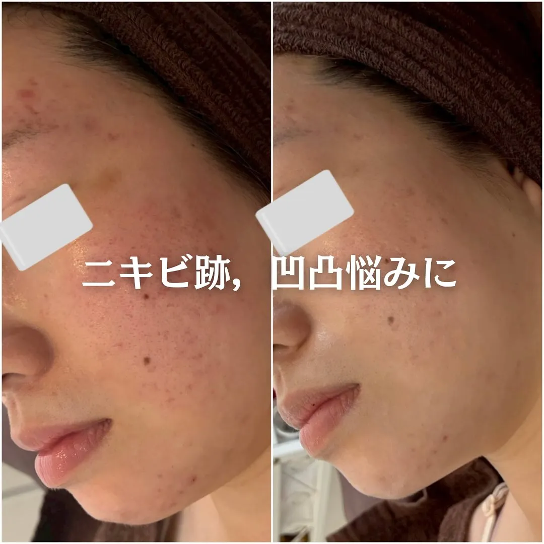 太田市にある頑固なニキビ専門店です✨️