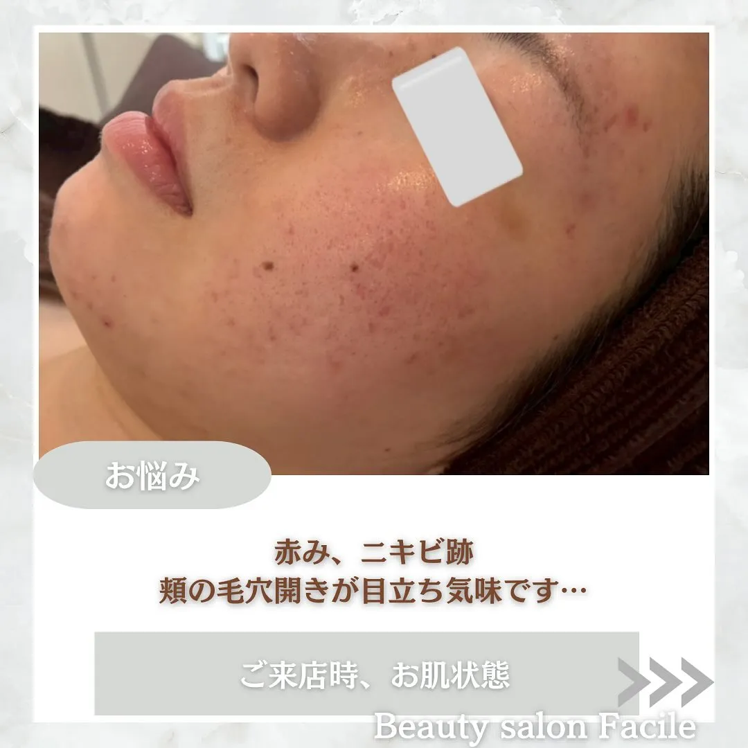 太田市にある頑固なニキビ専門店です✨️