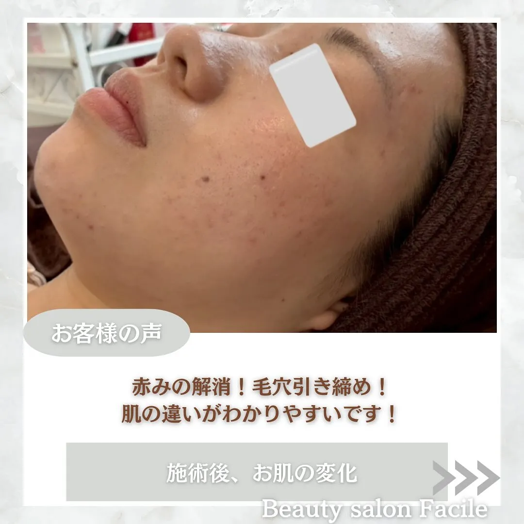 太田市にある頑固なニキビ専門店です✨️