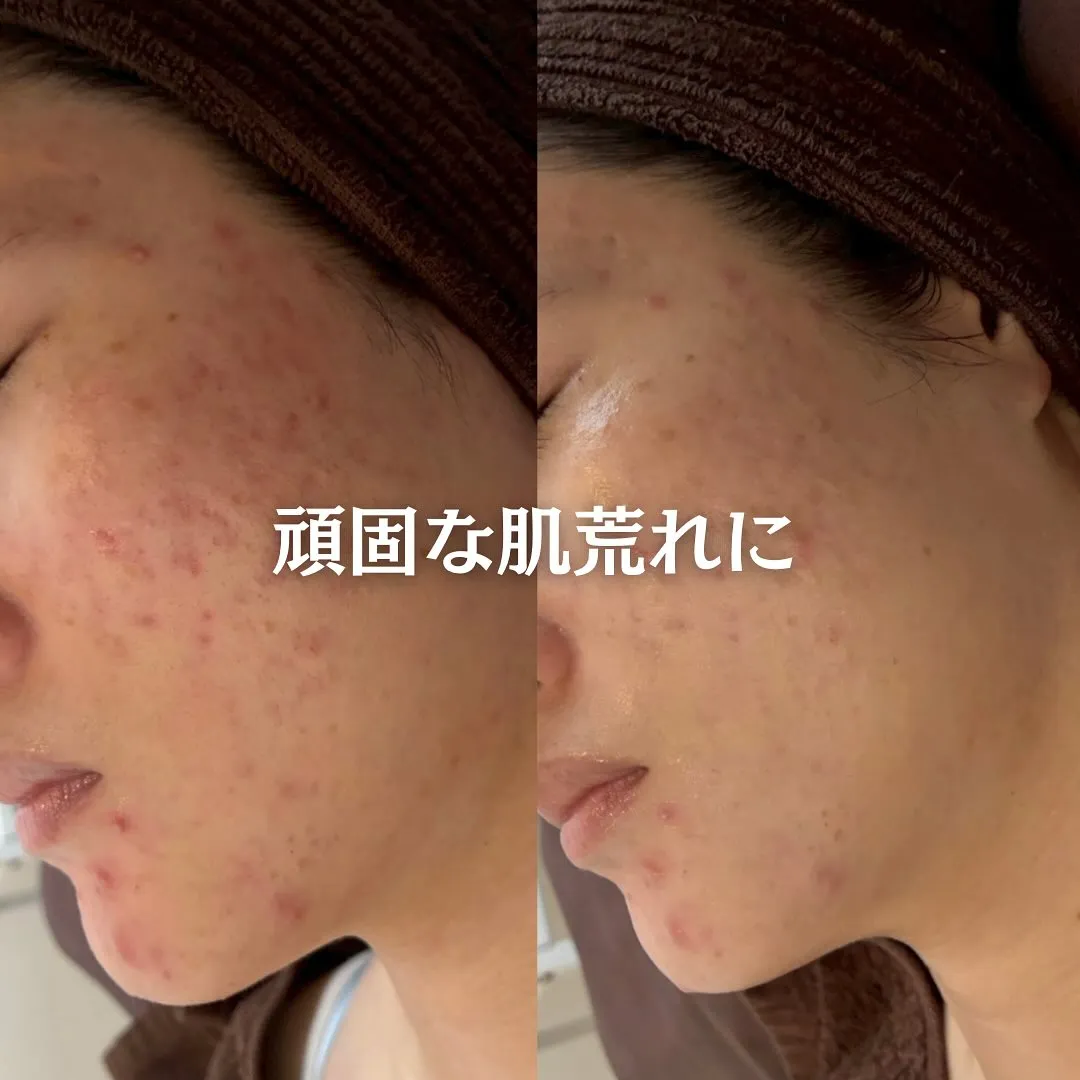 太田市にある頑固なニキビ専門店です✨️