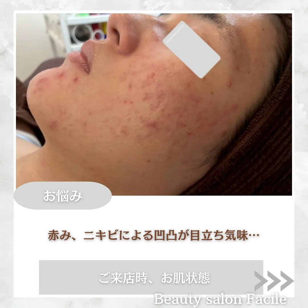 太田市にある頑固なニキビ専門店です✨️