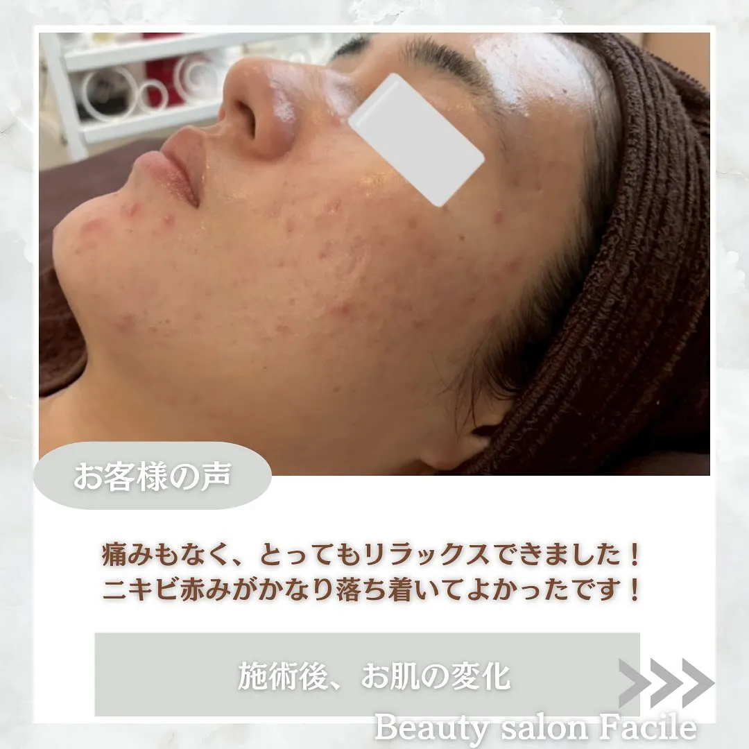 太田市にある頑固なニキビ専門店です✨️