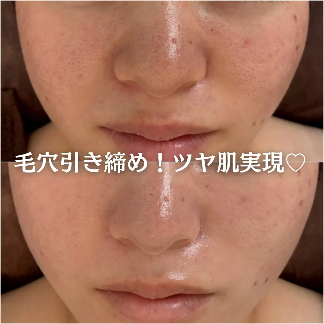 太田市にある頑固なニキビ専門店です✨️