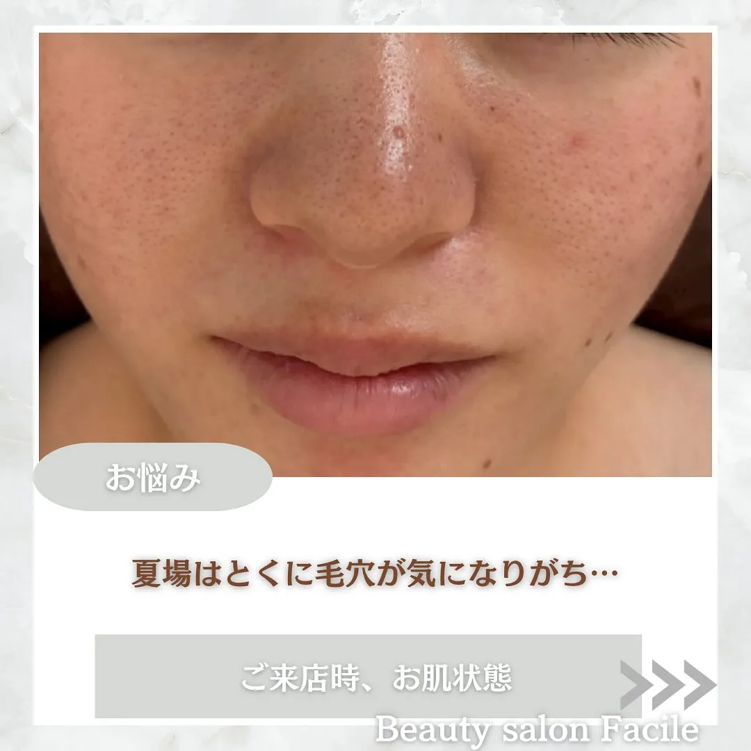 太田市にある頑固なニキビ専門店です✨️