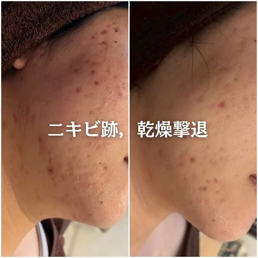 太田市にある頑固なニキビ専門店です✨️