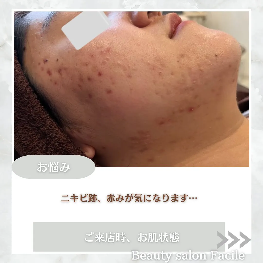 太田市にある頑固なニキビ専門店です✨️