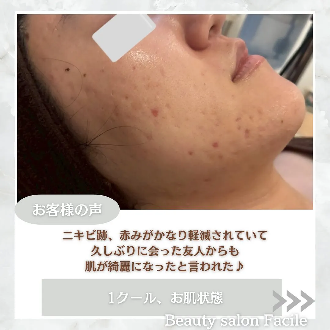 太田市にある頑固なニキビ専門店です✨️