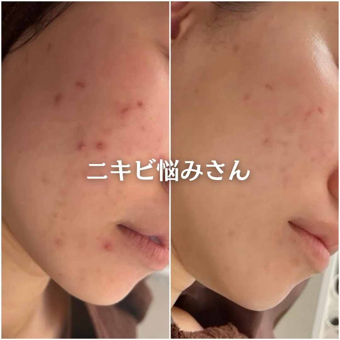 太田市にある頑固なニキビ専門店です✨️