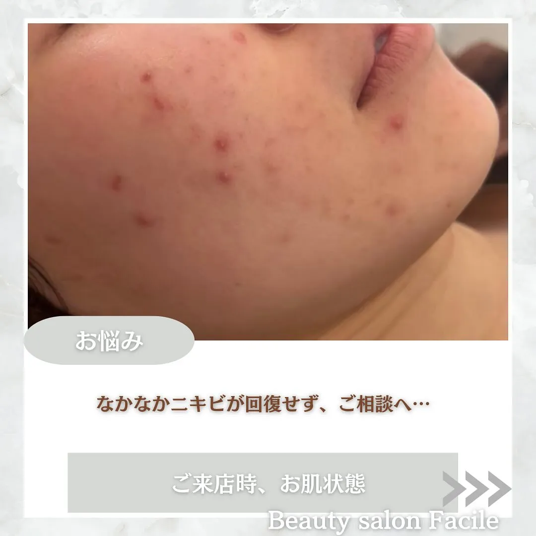 太田市にある頑固なニキビ専門店です✨️