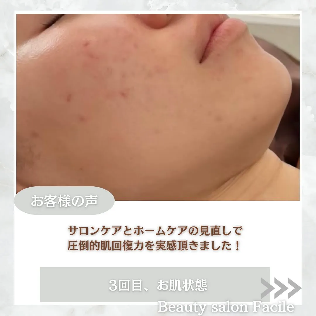 太田市にある頑固なニキビ専門店です✨️