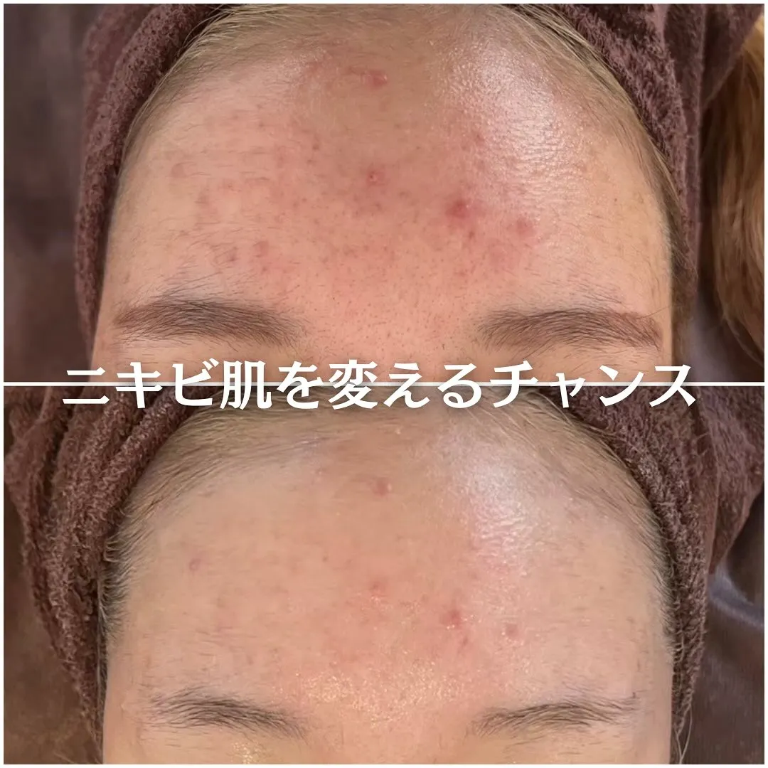 太田市にある頑固なニキビ専門店です✨️