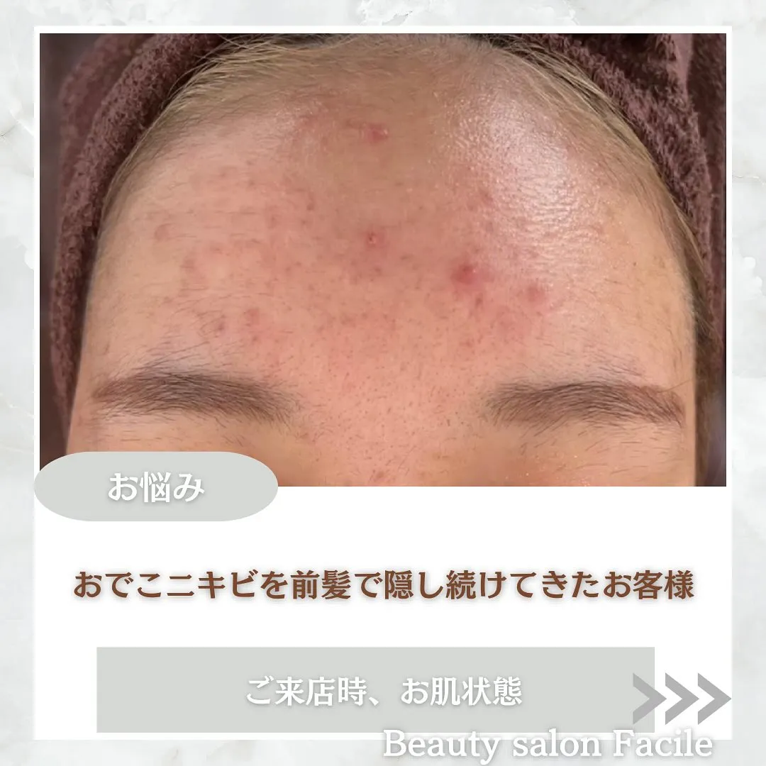 太田市にある頑固なニキビ専門店です✨️