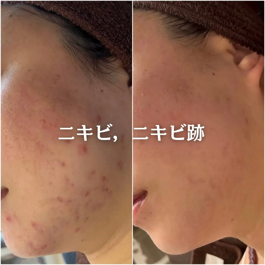 太田市にある頑固なニキビ専門店です✨️